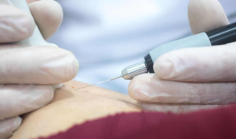 Pequena cirurgia dermatológica para remoção de lesão de pele em Londrina