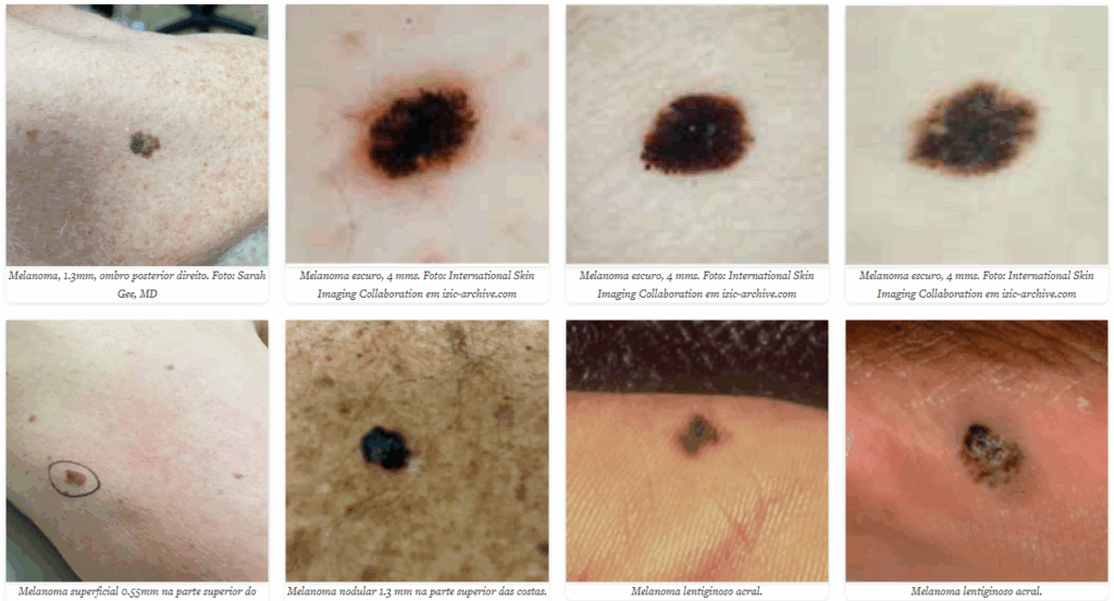 Diversos tipos de manchas e lesões suspeitas de câncer de pele.