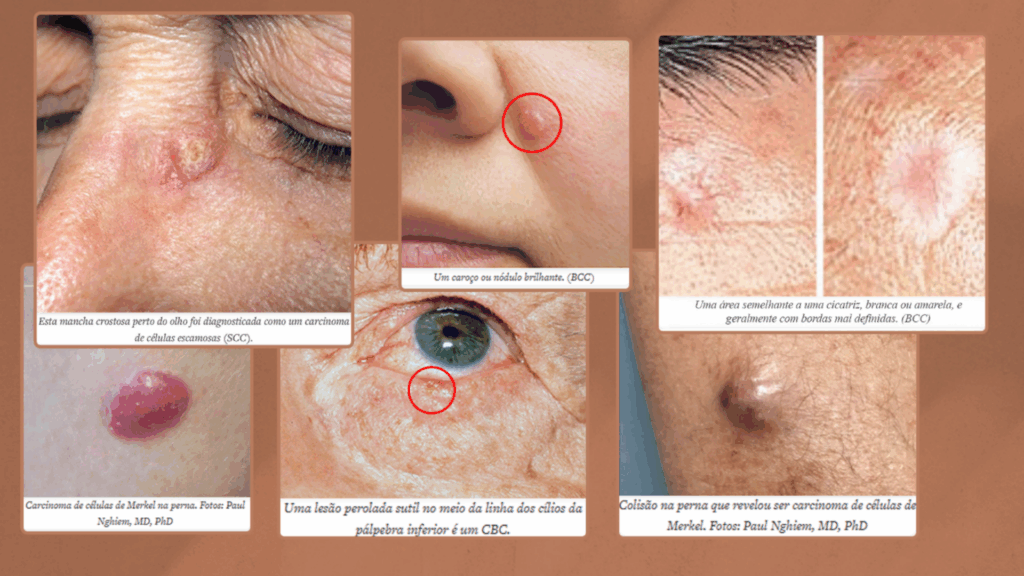 Lesões e manchas cutâneas suspeitas de câncer de pele